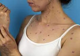 What Happened to Monkeypox?