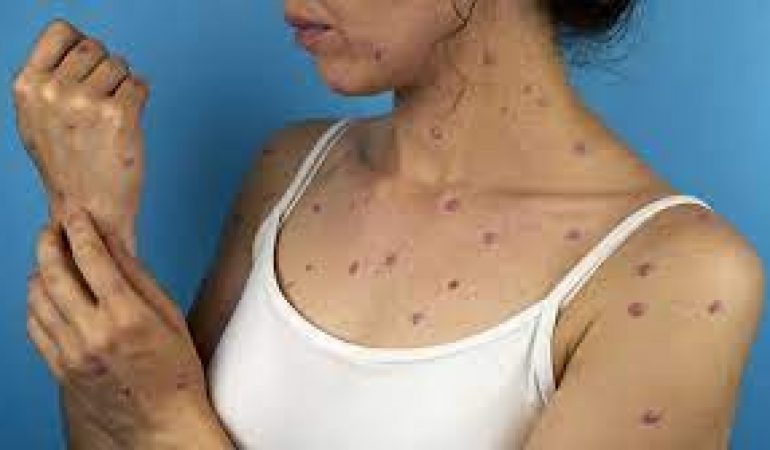 What Happened to Monkeypox?