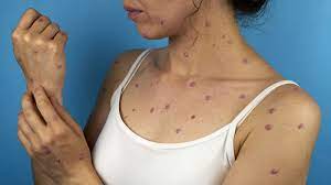 What Happened to Monkeypox?